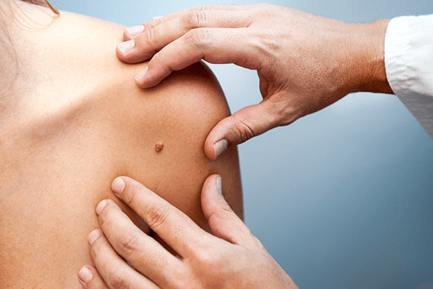 FREE Skin Cancer Screening